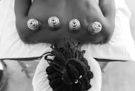 Cupping Therapy