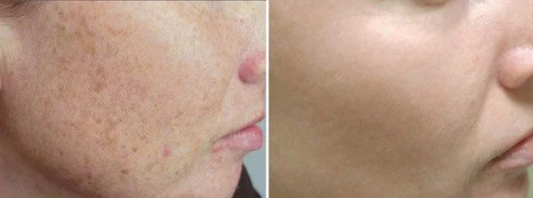 skin-renew-before-after.jpg