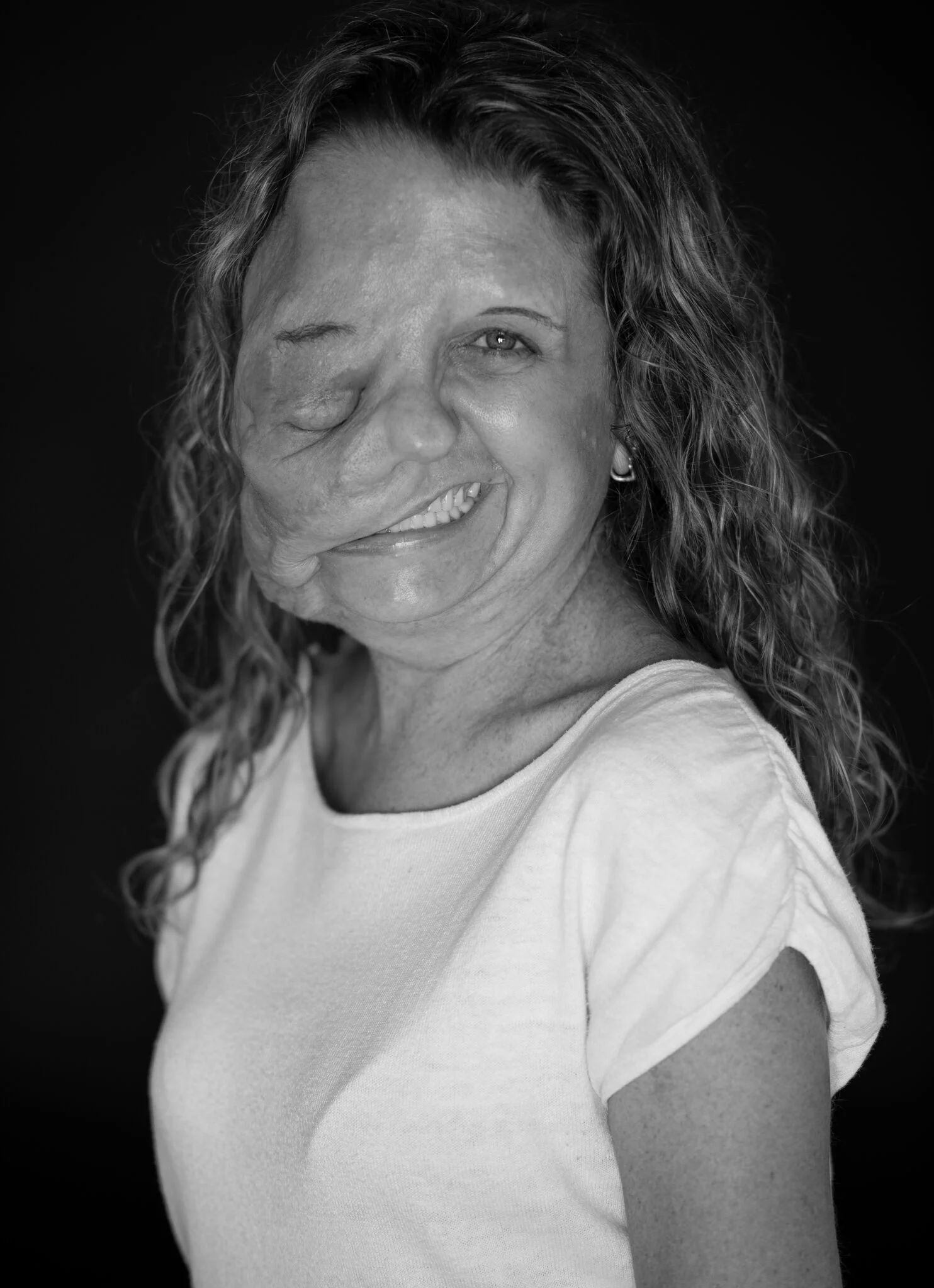 Fighter. “I’ve been told that I’m an inspiration, but I’m just living my life.” Elizabeth has tumors on the outside of her body which is due to a genetic disorder that she has carried since childhood, Neurofibromatosis (otherwise known as NF). The t…