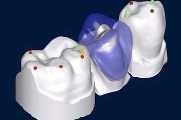 Exemple de couronnes dentaires réalisées grâce à la technologie CAD / CAM.