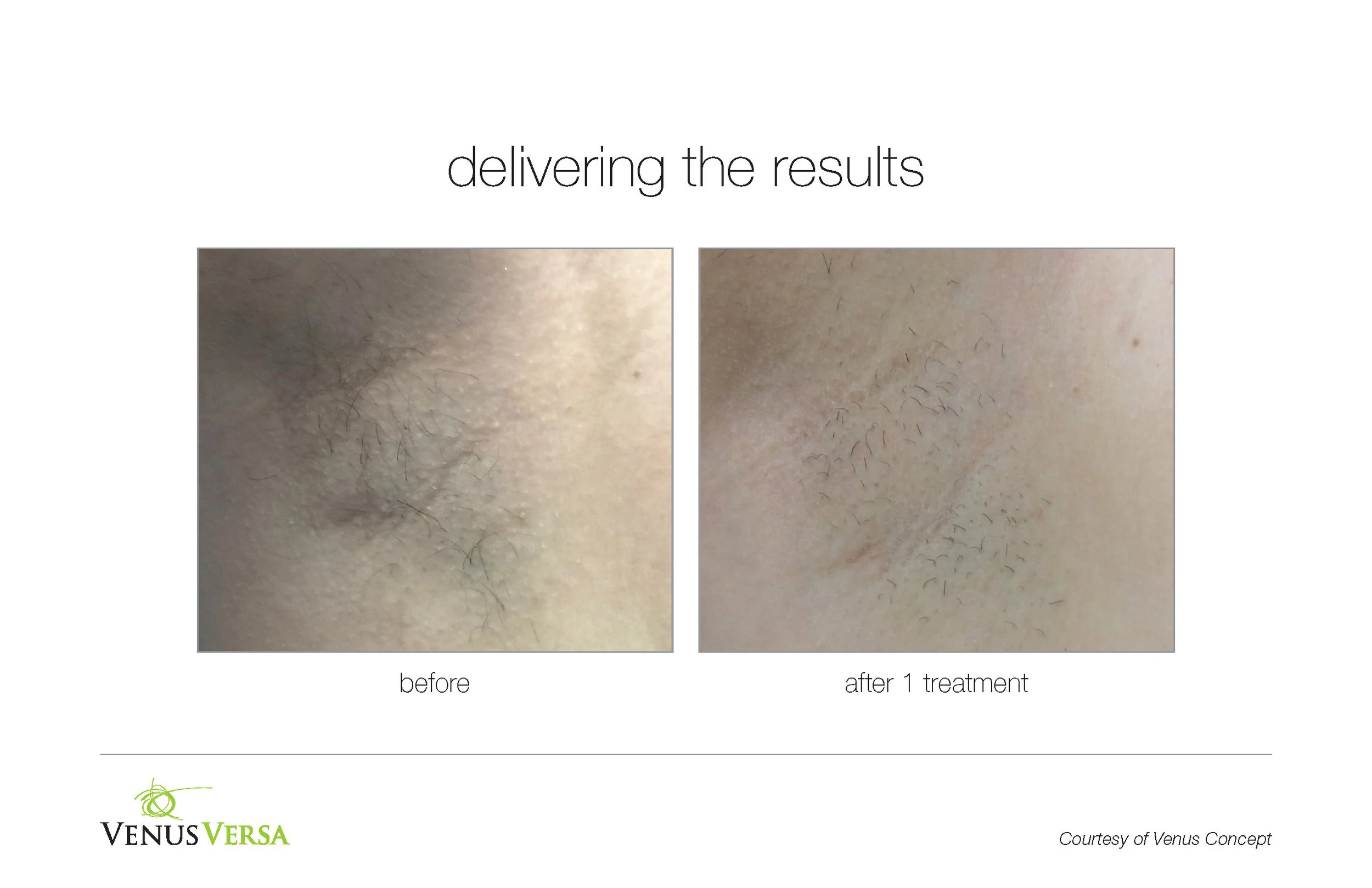 Underarm hair removal after 1 treatment