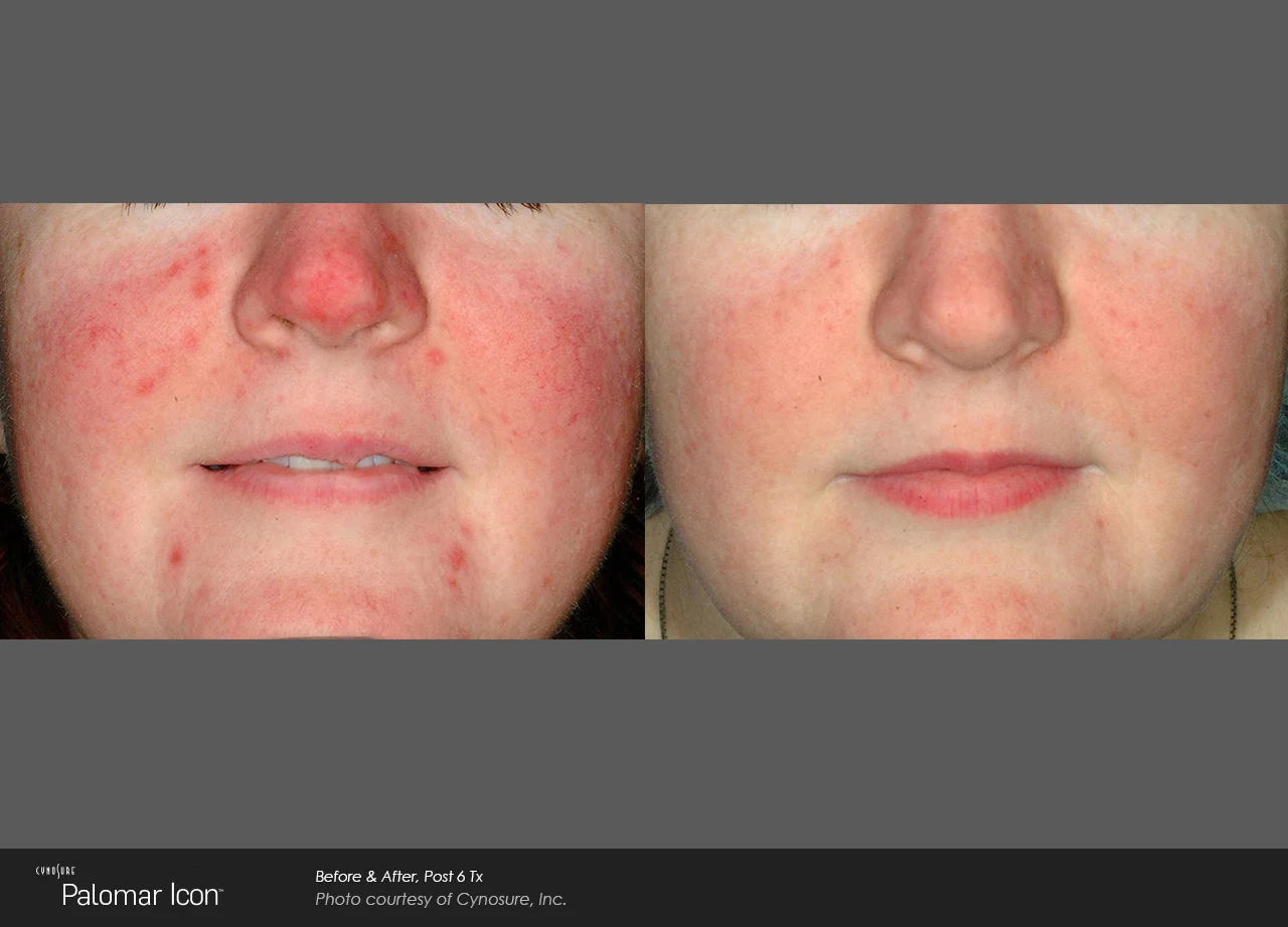 Icon_PalCyno_Rosacea_Post6Tx.jpg