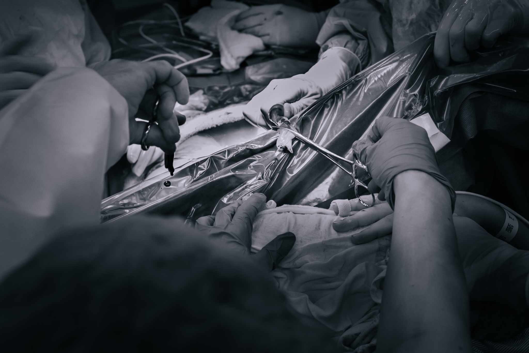 Cutting the umbilical cord in a cesarean section. 