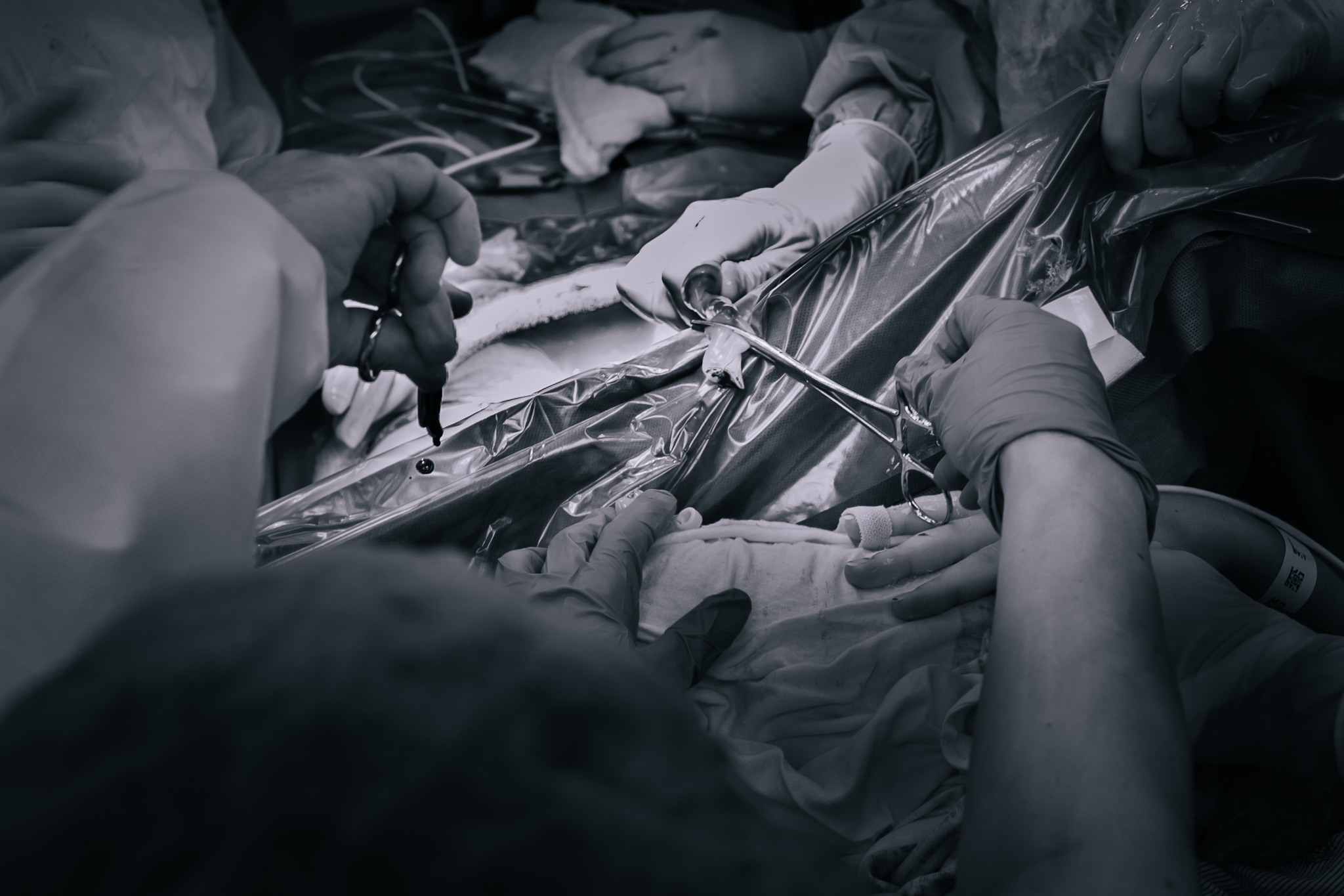 Cutting the umbilical cord in a cesarean section.