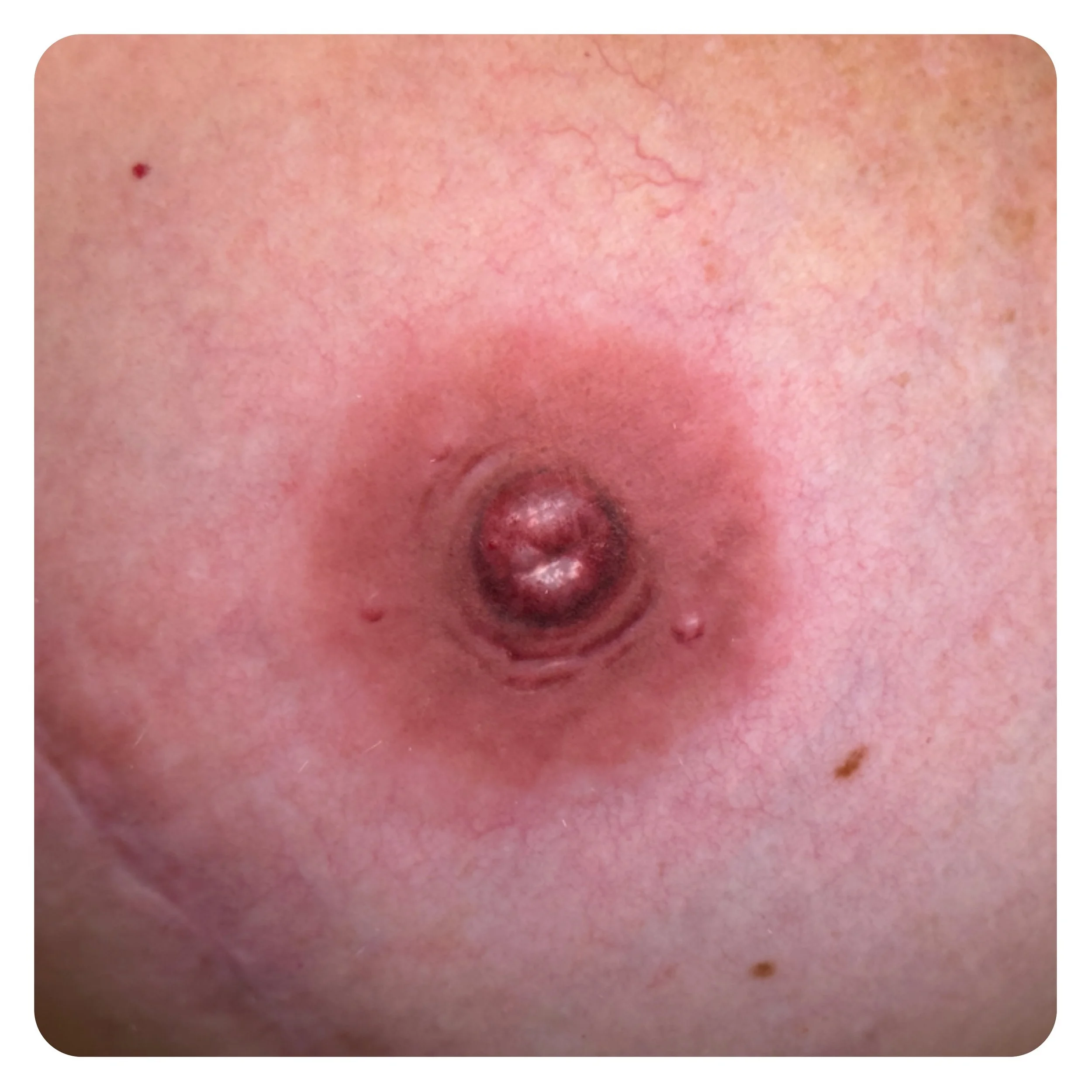 RESTORATIVE TATTOOING