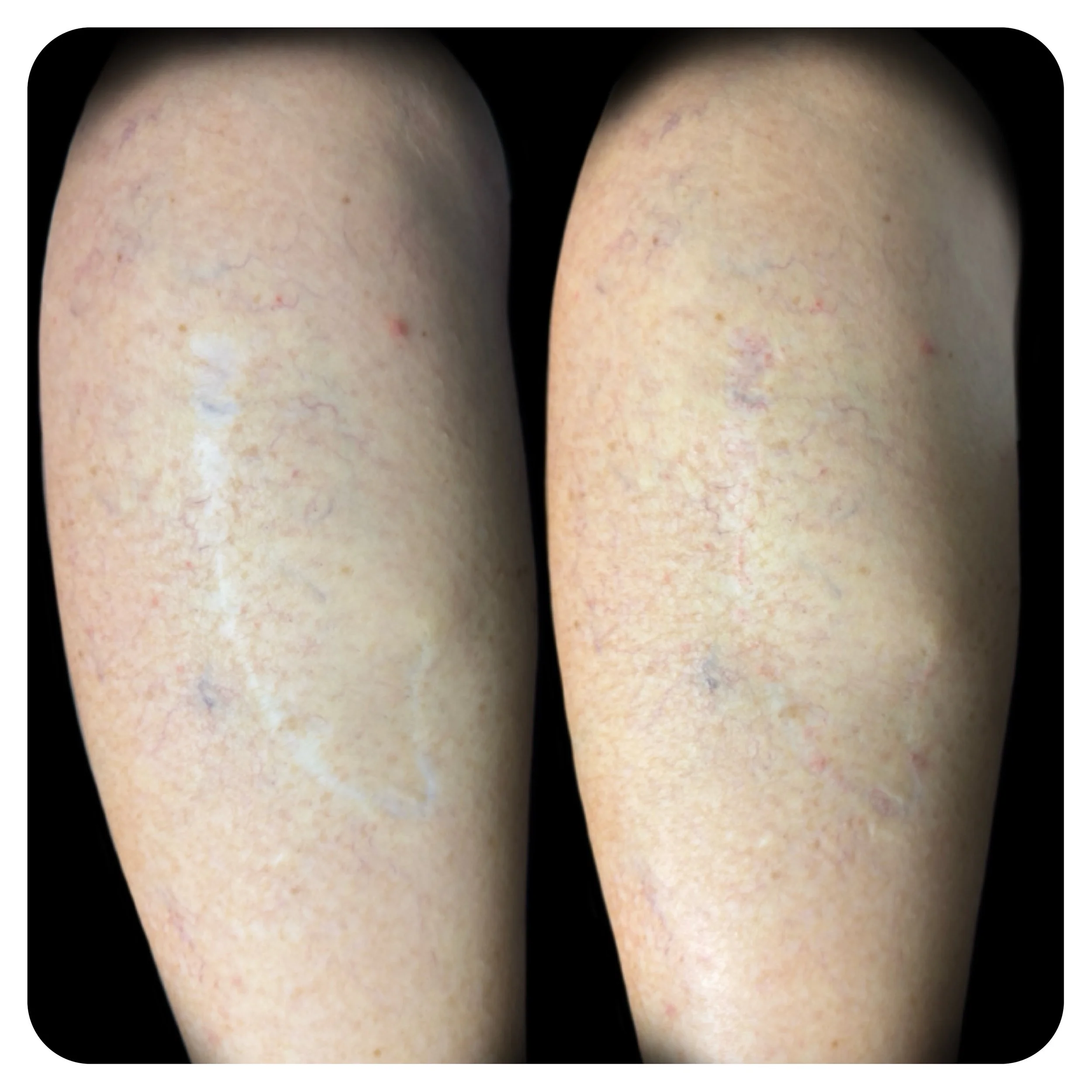 SCAR REVISION