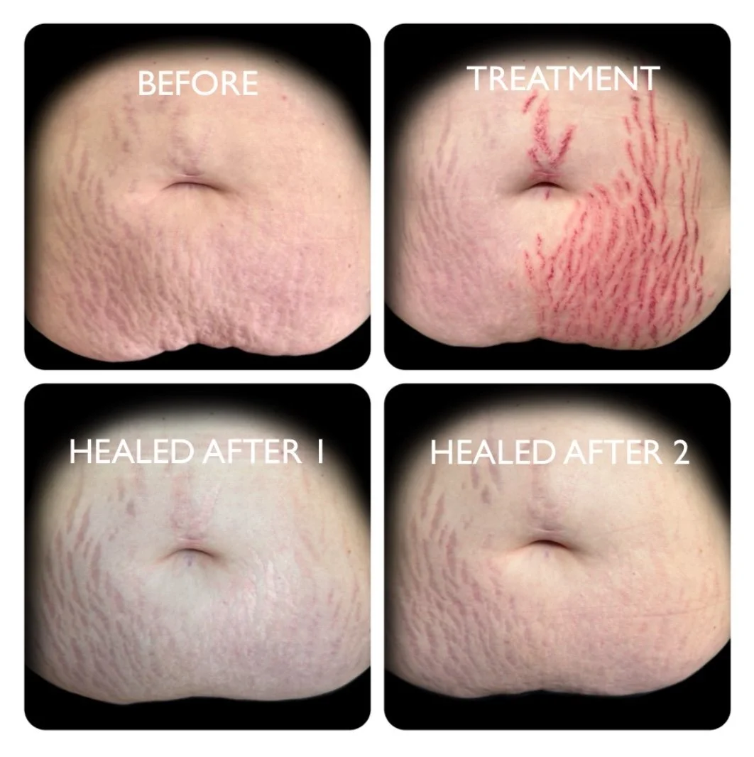 stretch mark treatments