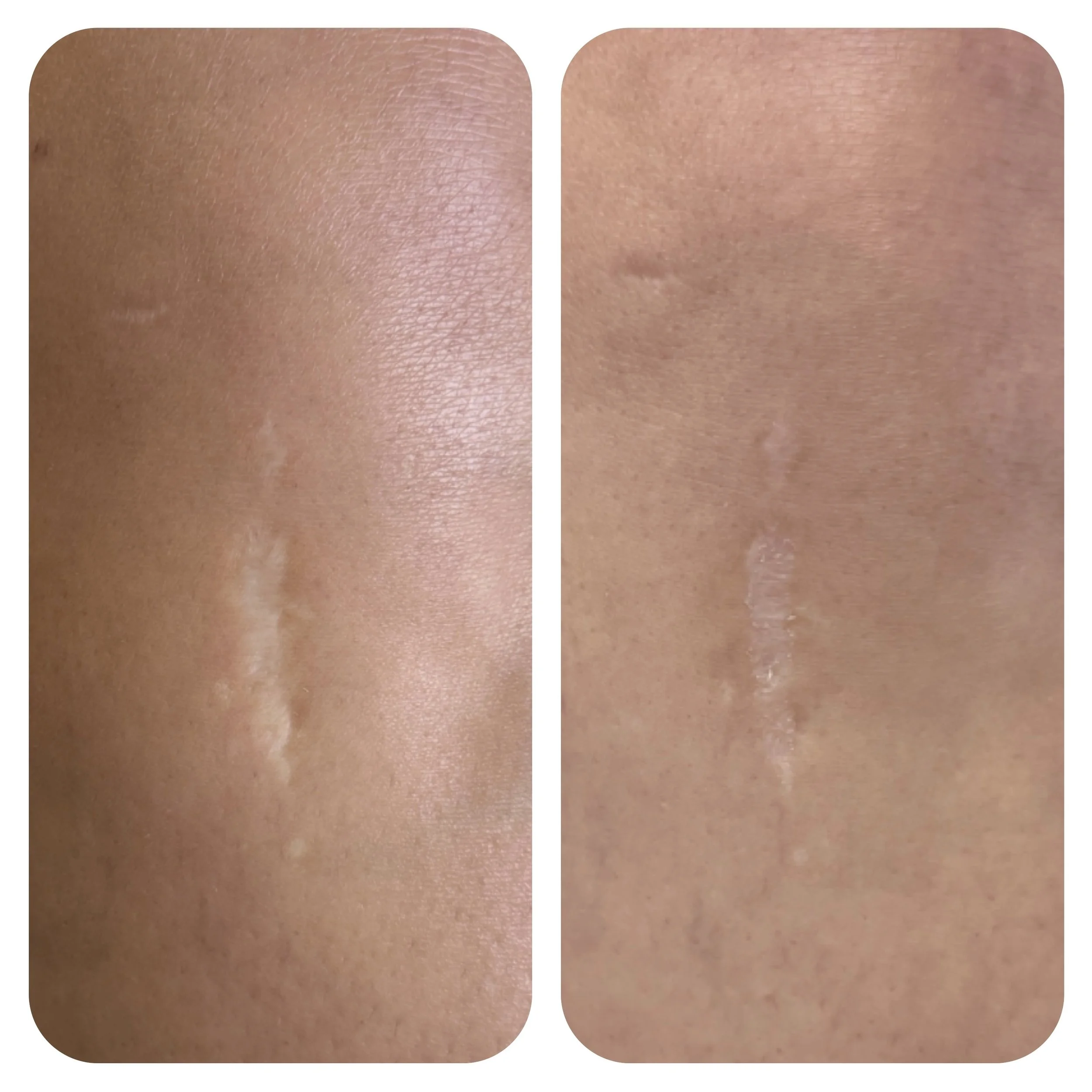 scar needling