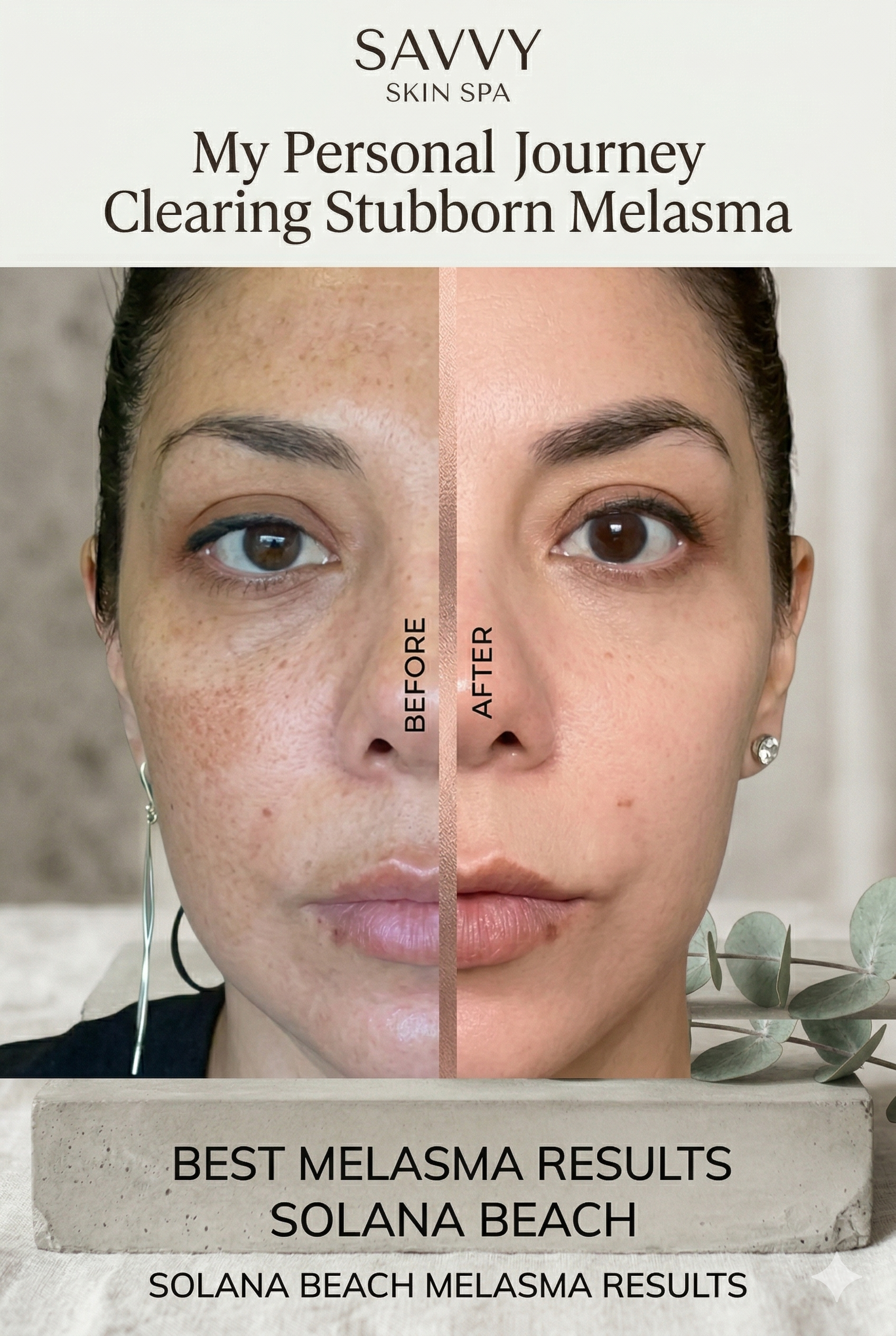 How I Treated My Melasma Without Lasers: My Personal Skincare Journey