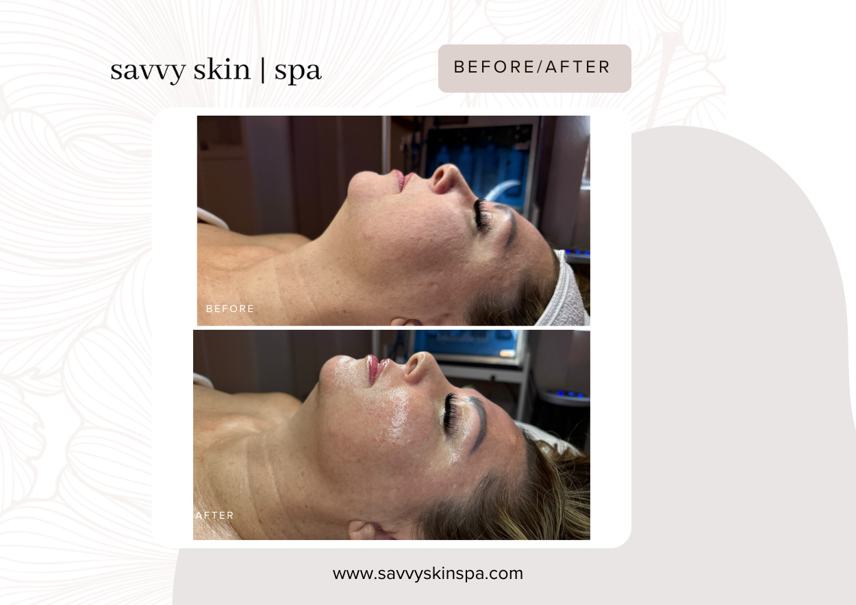 Glass Facial