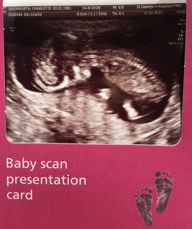 12-week-scan
