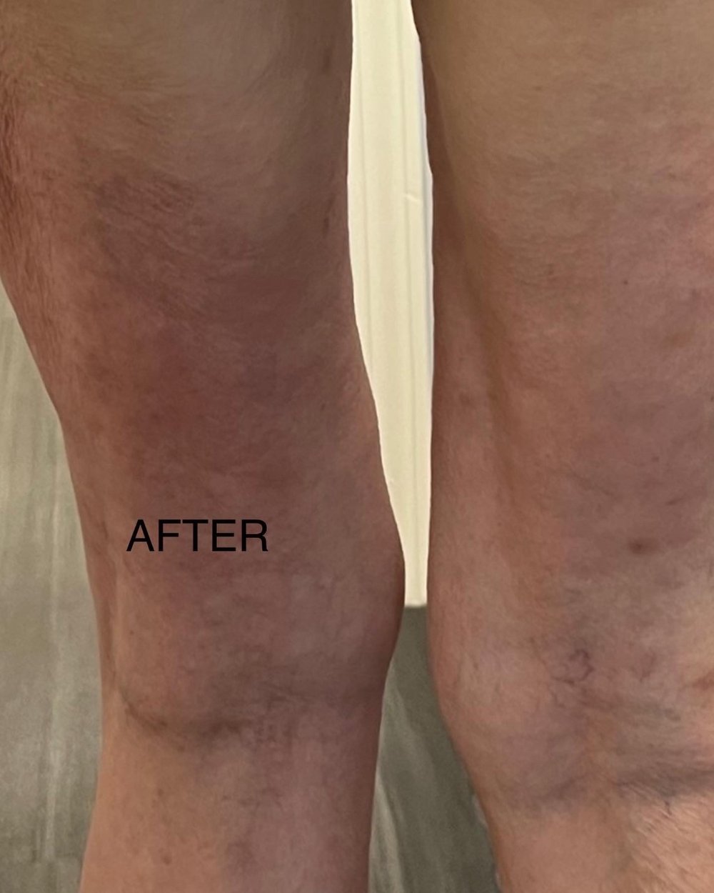 Cellulite Reduction-Vacuum Therapy — Baire - Hair Removal Specialists