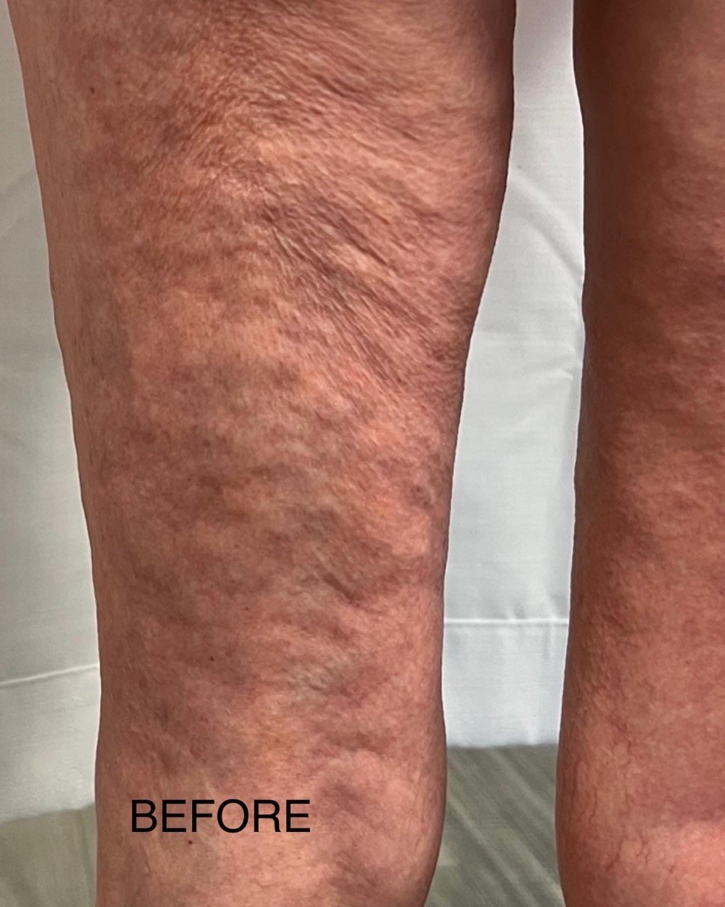 Cellulite Reduction-Vacuum Therapy — Baire