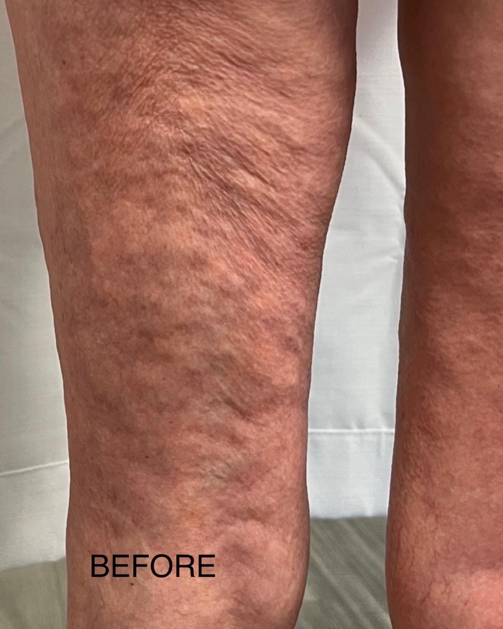 Cellulite ReductionVacuum Therapy — Baire