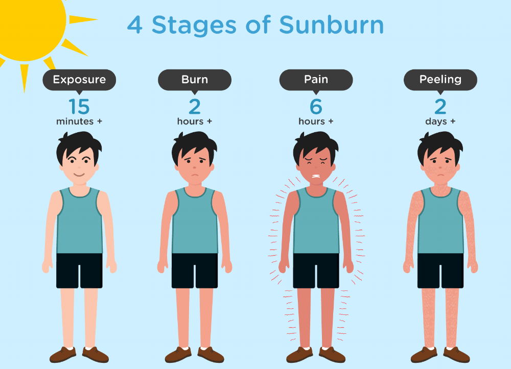 The-4-Stages-of-Sunburn3.png