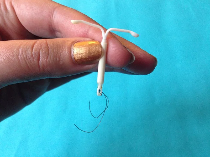 Here’s an IUD that was inside a woman’s uterus for four years. (Image by Sarahmirk, via Wikimedia Commons.)