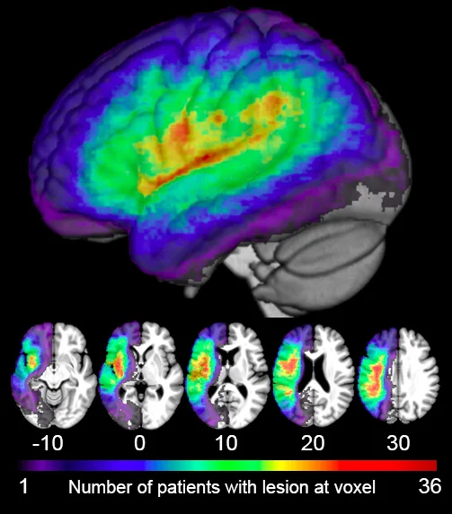 R01- right hemisphere- Revised- lesion overlap figure.jpg