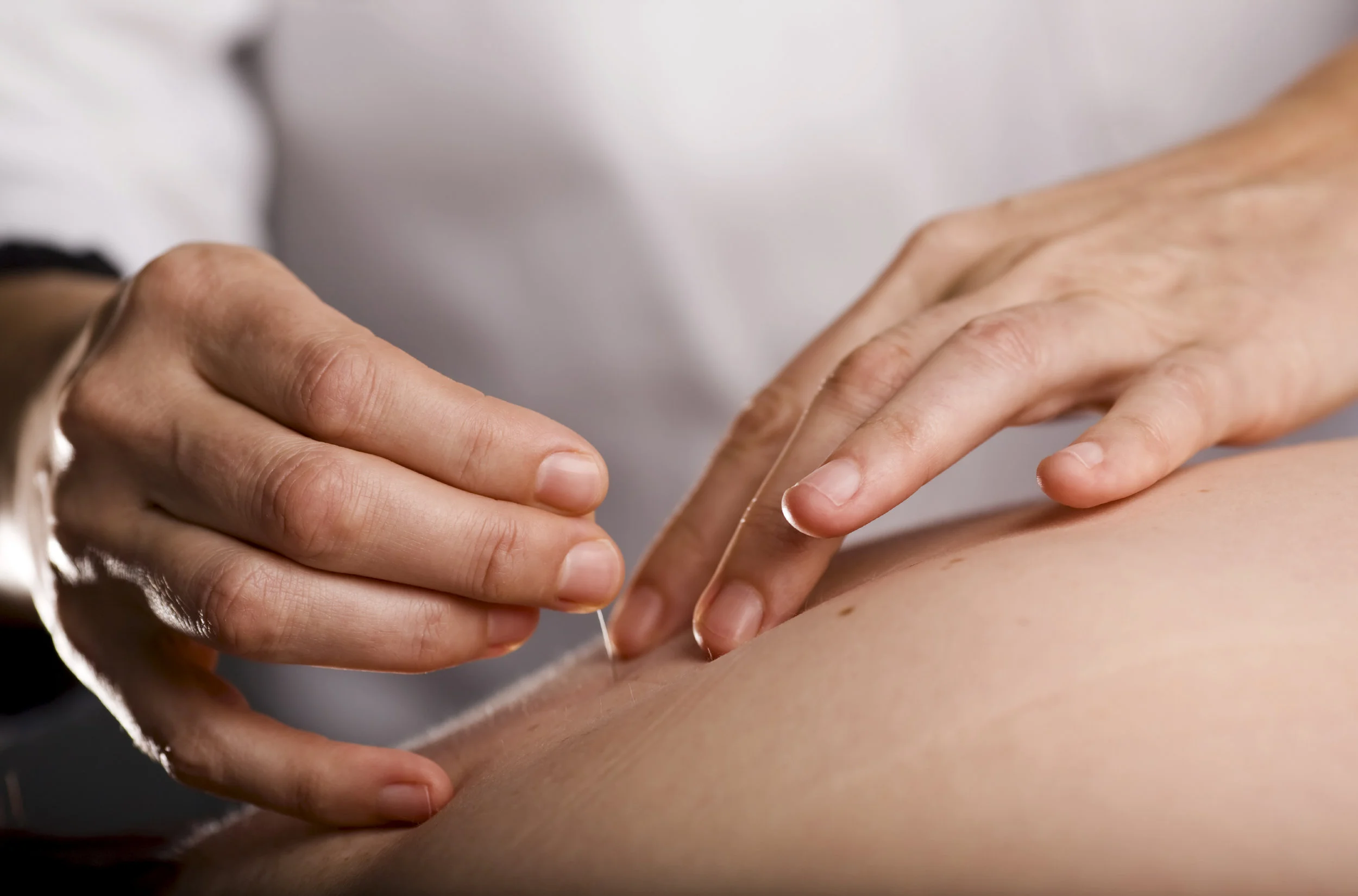 Hands-inserting-an-acupuncture-needle-into-skin.jpg
