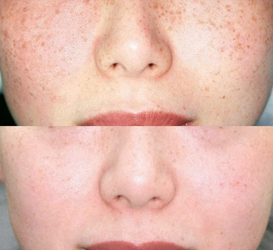 Brown spots