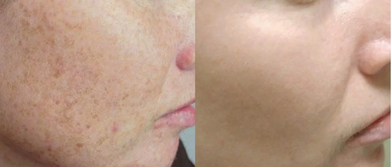 Brown spots