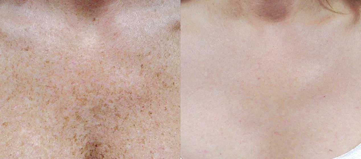 Brown spots