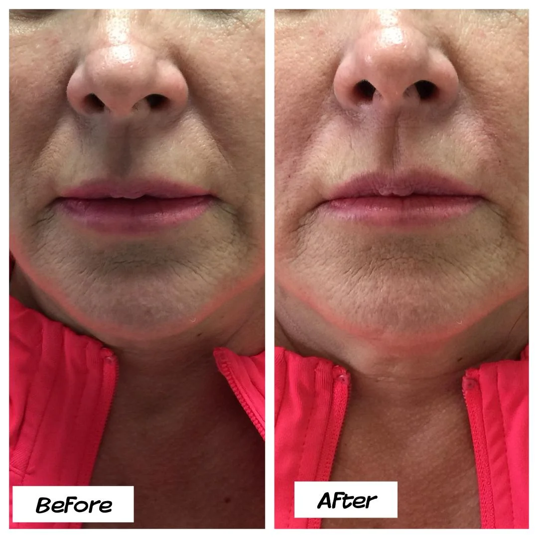 Lip contouring and wrinkles improvement