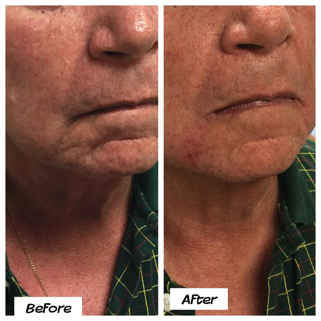 Wrinkle improvement