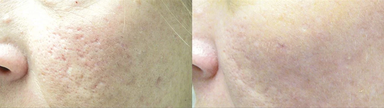 Acne Scars