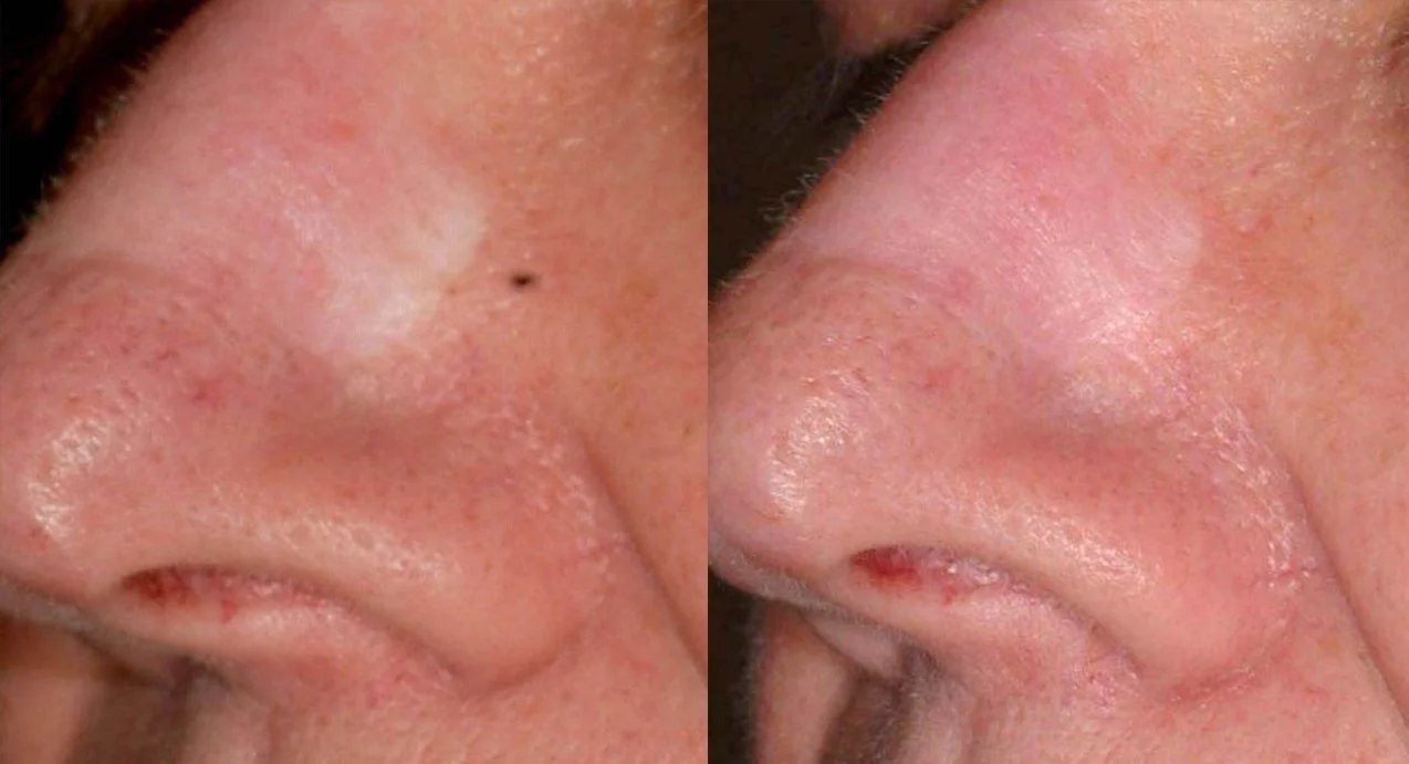 Surgical Scar
