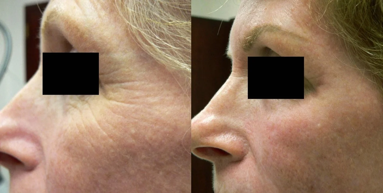 Treatment of fine lines/wrinkles