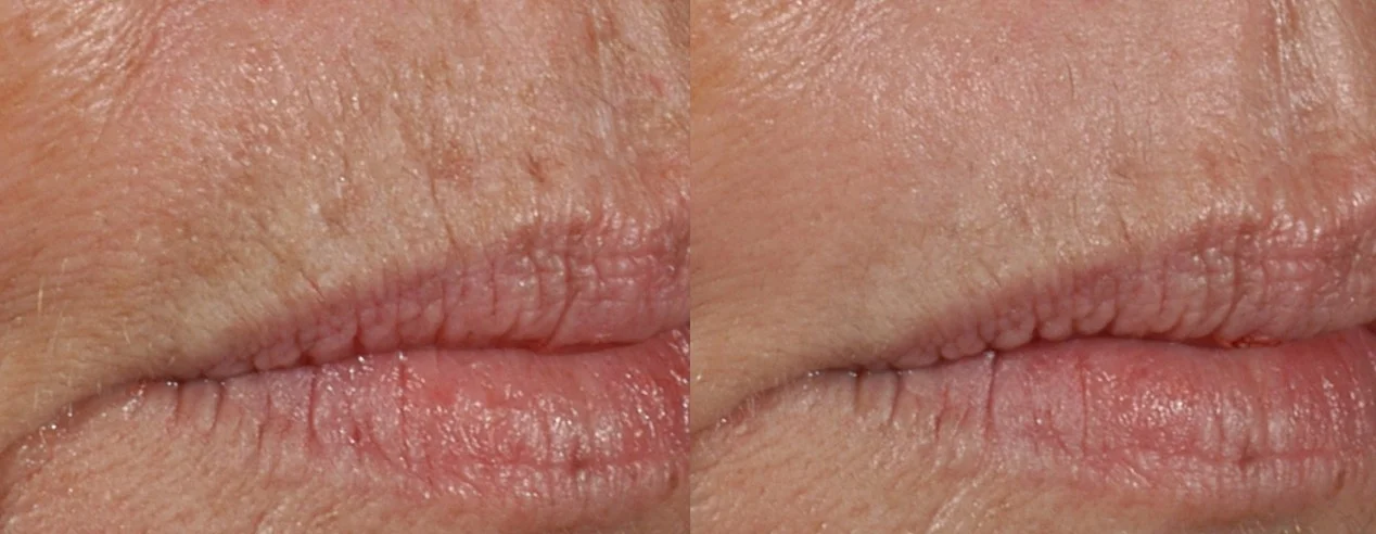 Treatment of lip lines