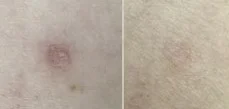 Scar From Biopsy