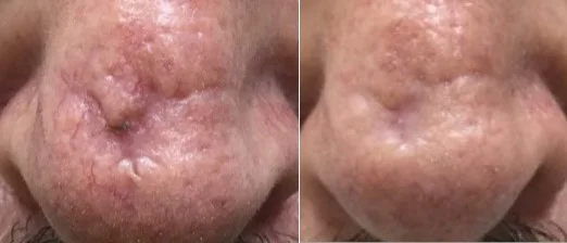 Surgical Scar