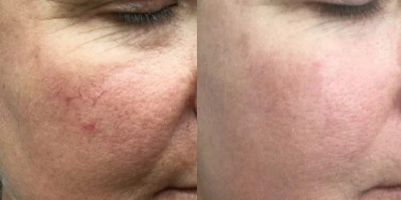 Facial Blood Vessels