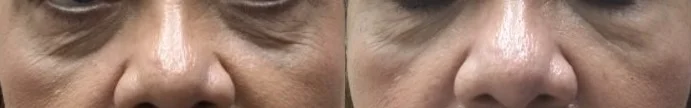 Infraorbital volume replacement