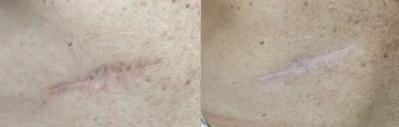 Surgical Scar