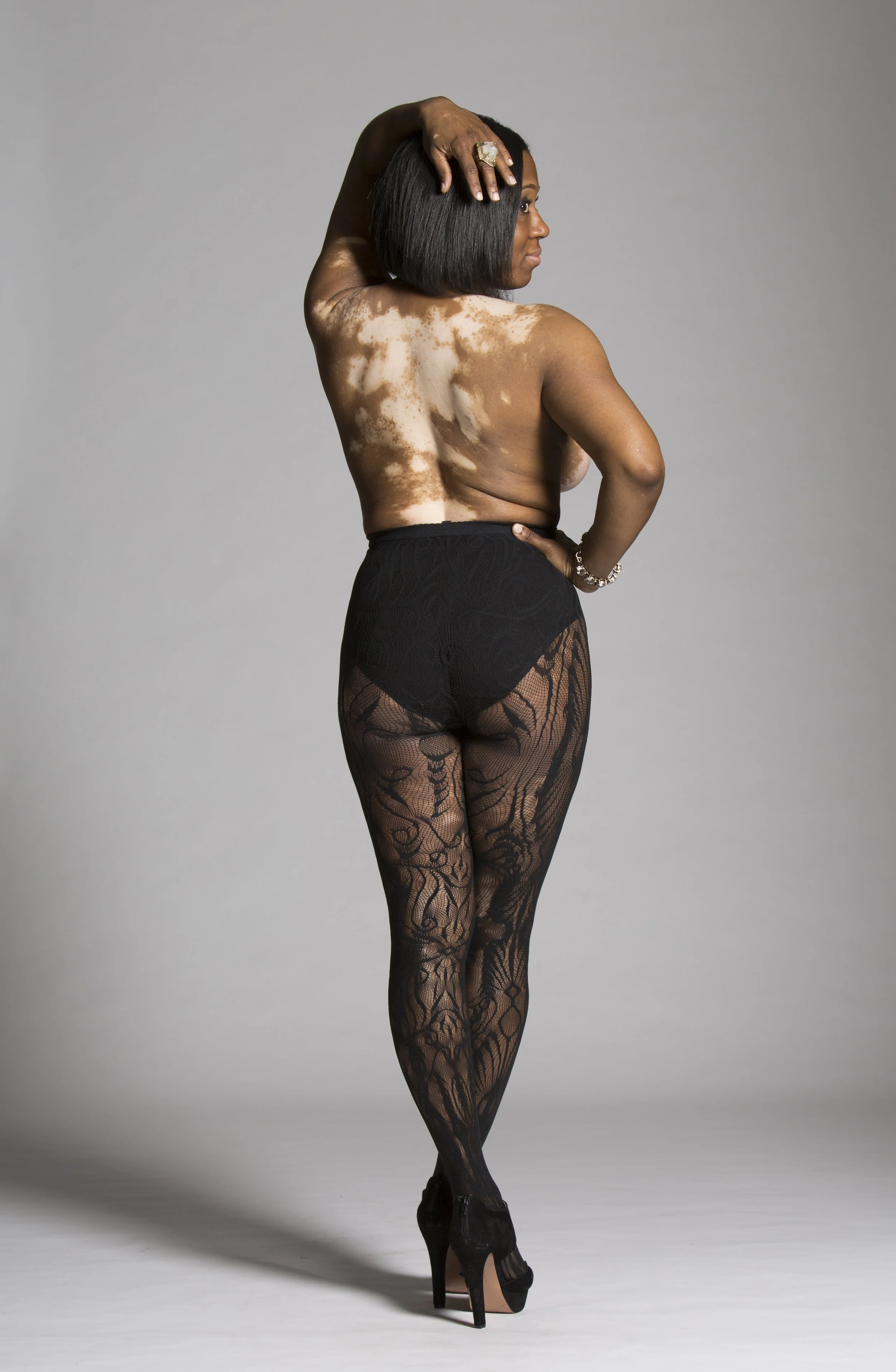Dayka Robinson, Vitiligo back 2015.jpg