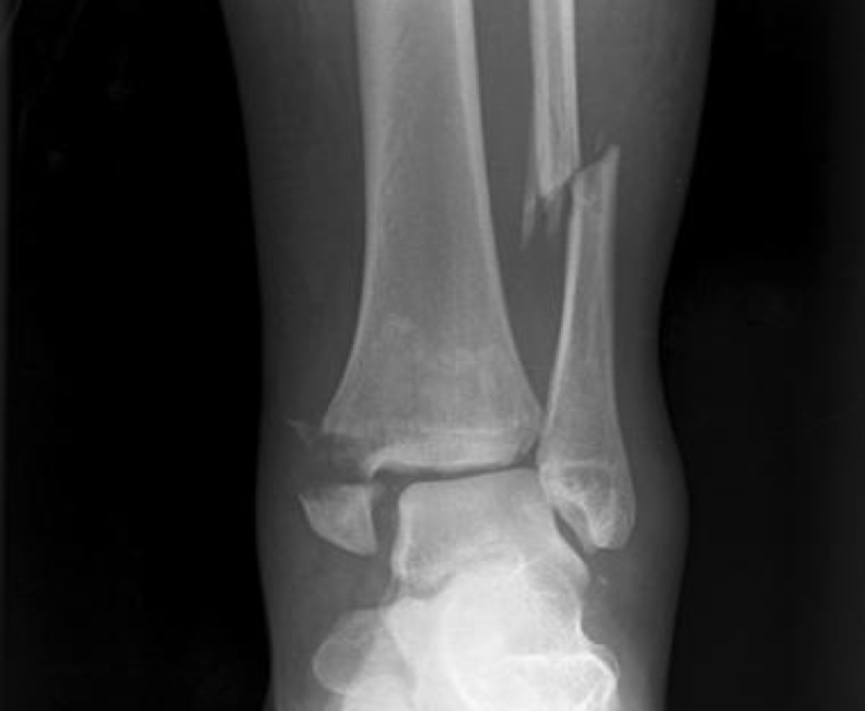 Трещина голени. Перелом малоберцовой кости рентген. Перелом берцовой кости рентген. Перелом малоберцовой кости на ноге. Перелом диафиза большеберцовой кости рентген.