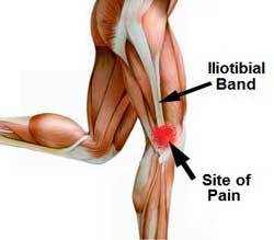 Iliotibial Band Syndrome Exercises - ITB Friction Syndrome