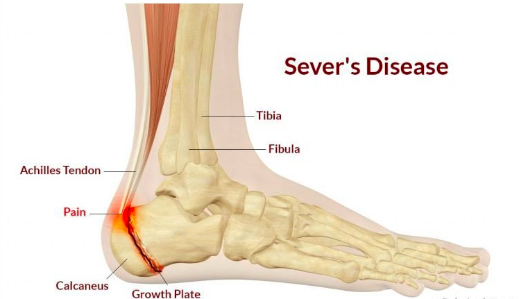 Disease Sore Heel Causes Sever's Disease Causes Of Sore Heel