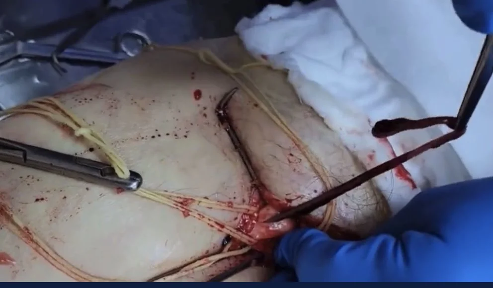 Embalmers Remove Strange, Long Blood Clots From Vaccinated Corpses