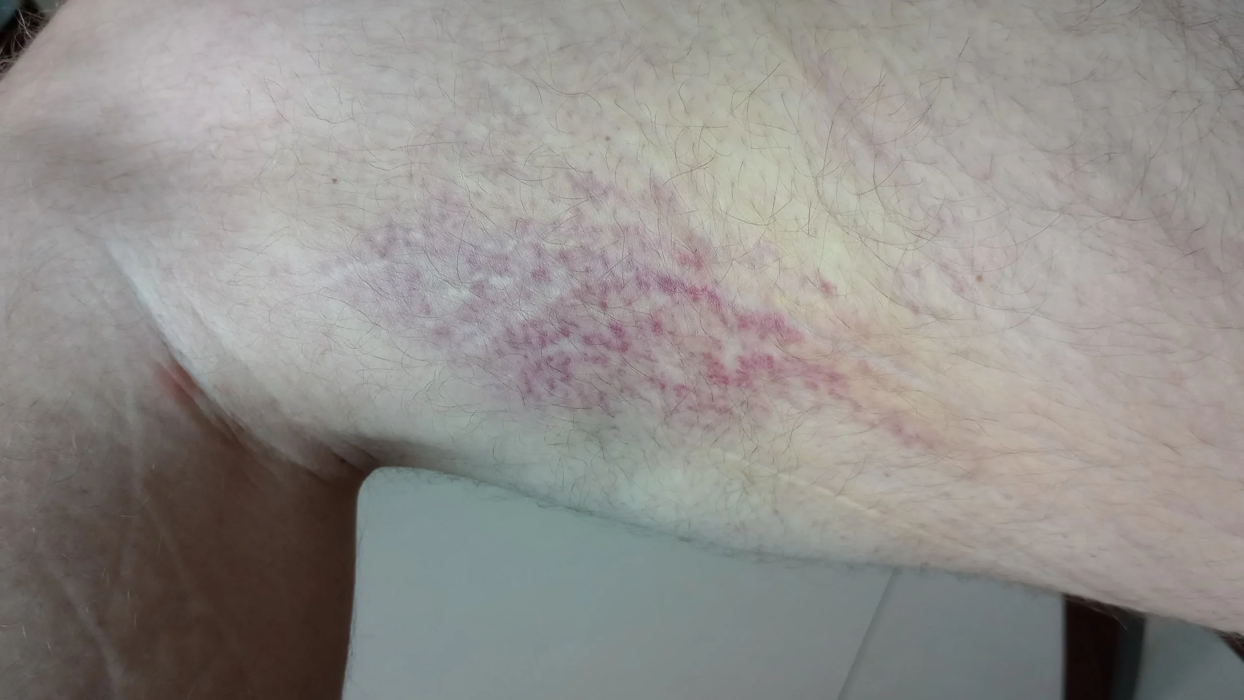 230926 blue leg 1.jpeg