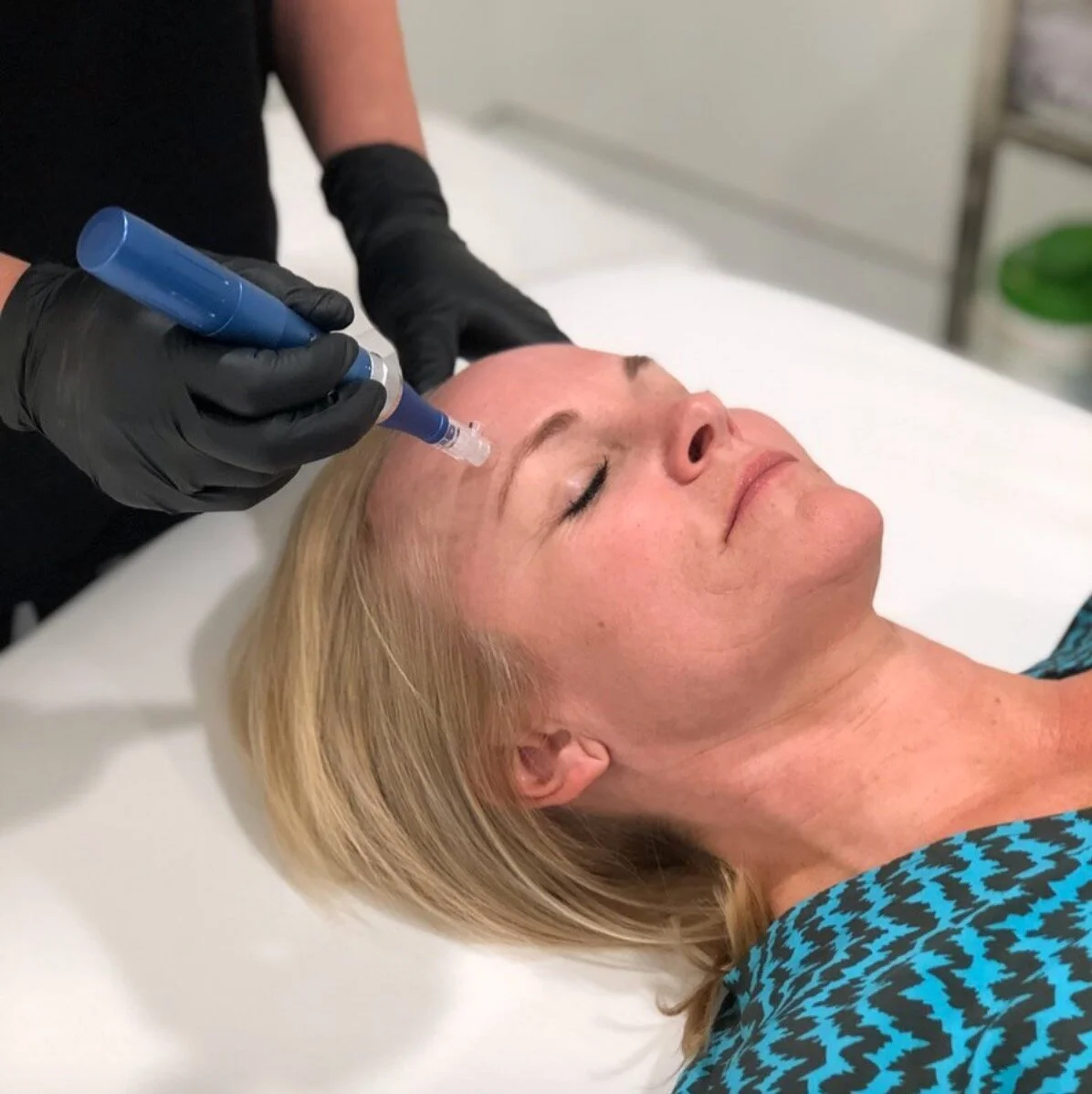 MICRONEEDLING