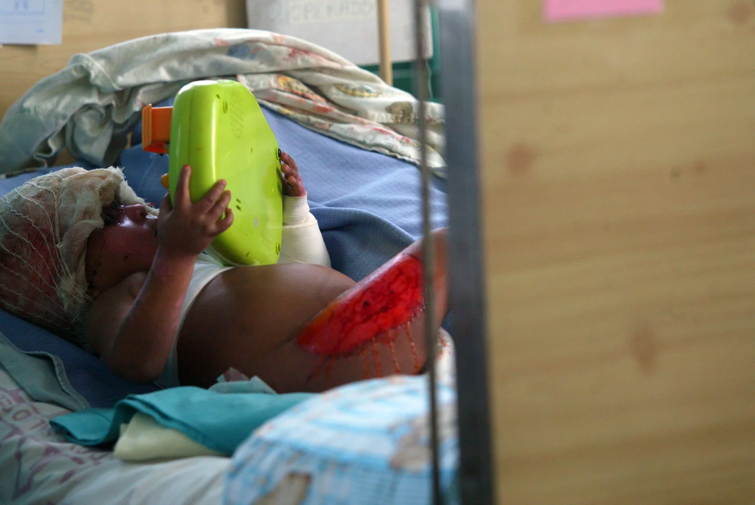 NIÑOS QUEMADOS-yael1556.JPG