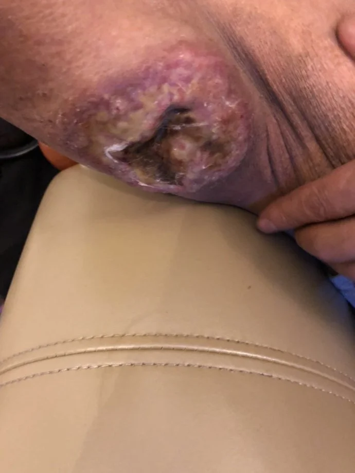 after treatment