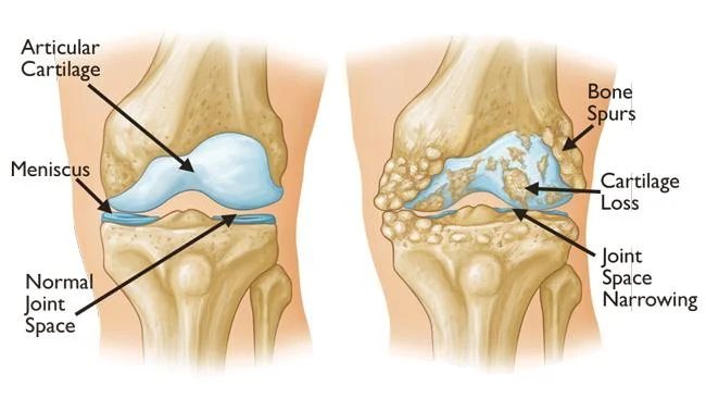 knee OA.jpg