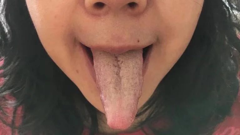 中医治疗舌象对比案例