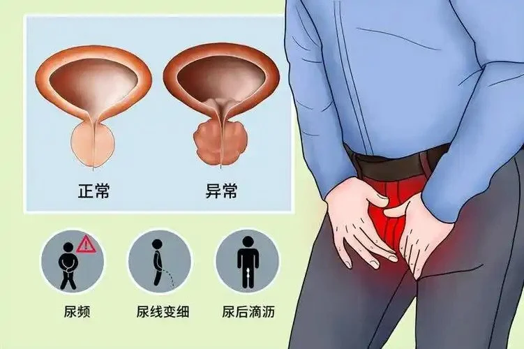 前列腺肿大病案分享