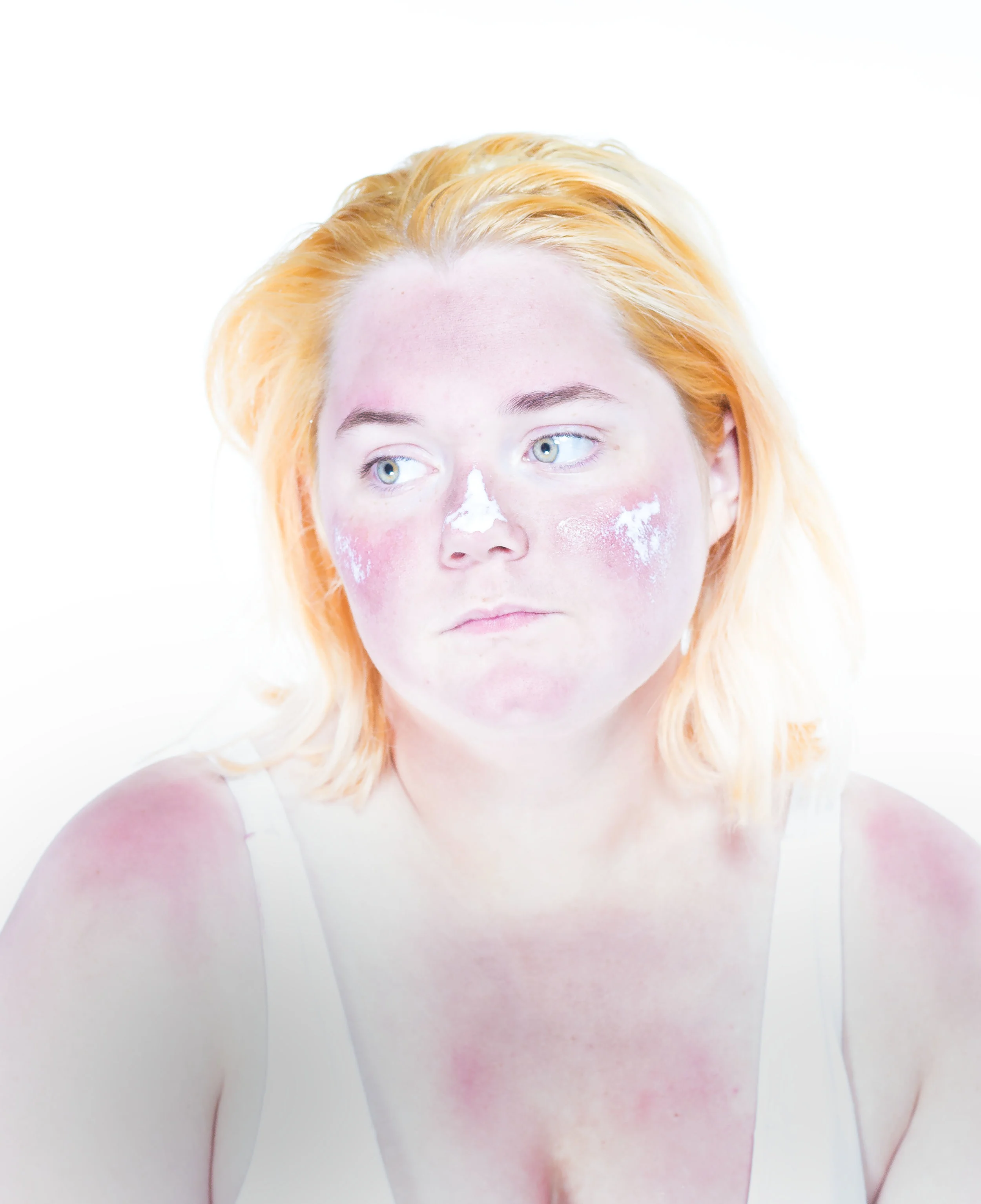 Sunburn , September 2017