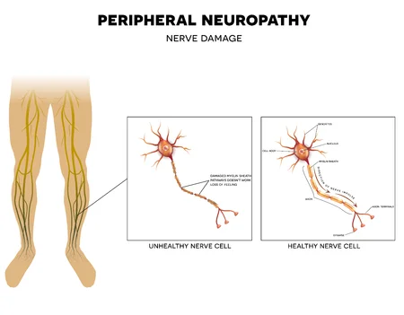 diabetes-peripheral-neuropathy-nerve-damage.jpg
